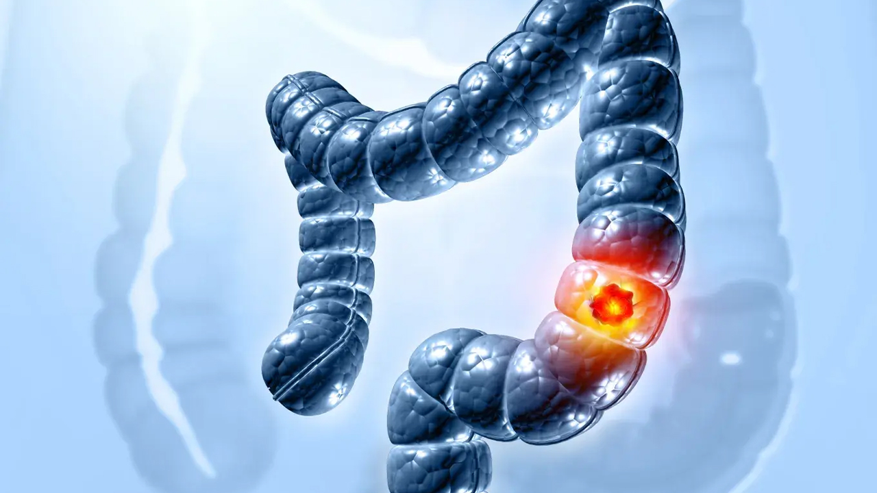 Colon Cancer In Young Adults |పేగులలో దాగి ఉన్న ముప్పు